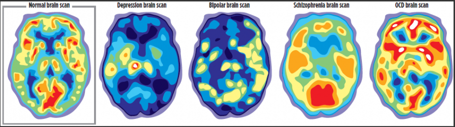 Positron emission tomography (PET) scans can compare brain activity during periods of depression with normal brain activity.  Graphic provided by Mayo Clinic